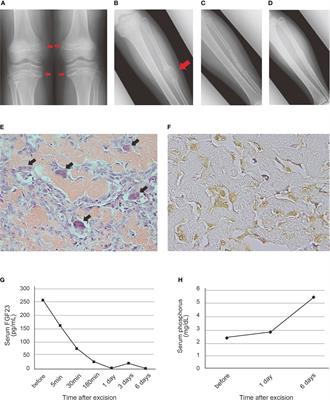 Case report: Novel NIPBL-BEND2 fusion gene identified in osteoblastoma-like phosphaturic mesenchymal tumor of the fibula